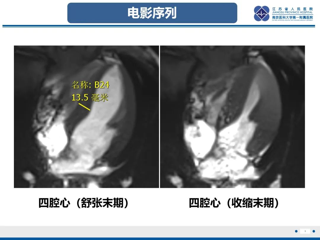 影像PPT - 【PPT】法布里病（Fabry Disease）-4