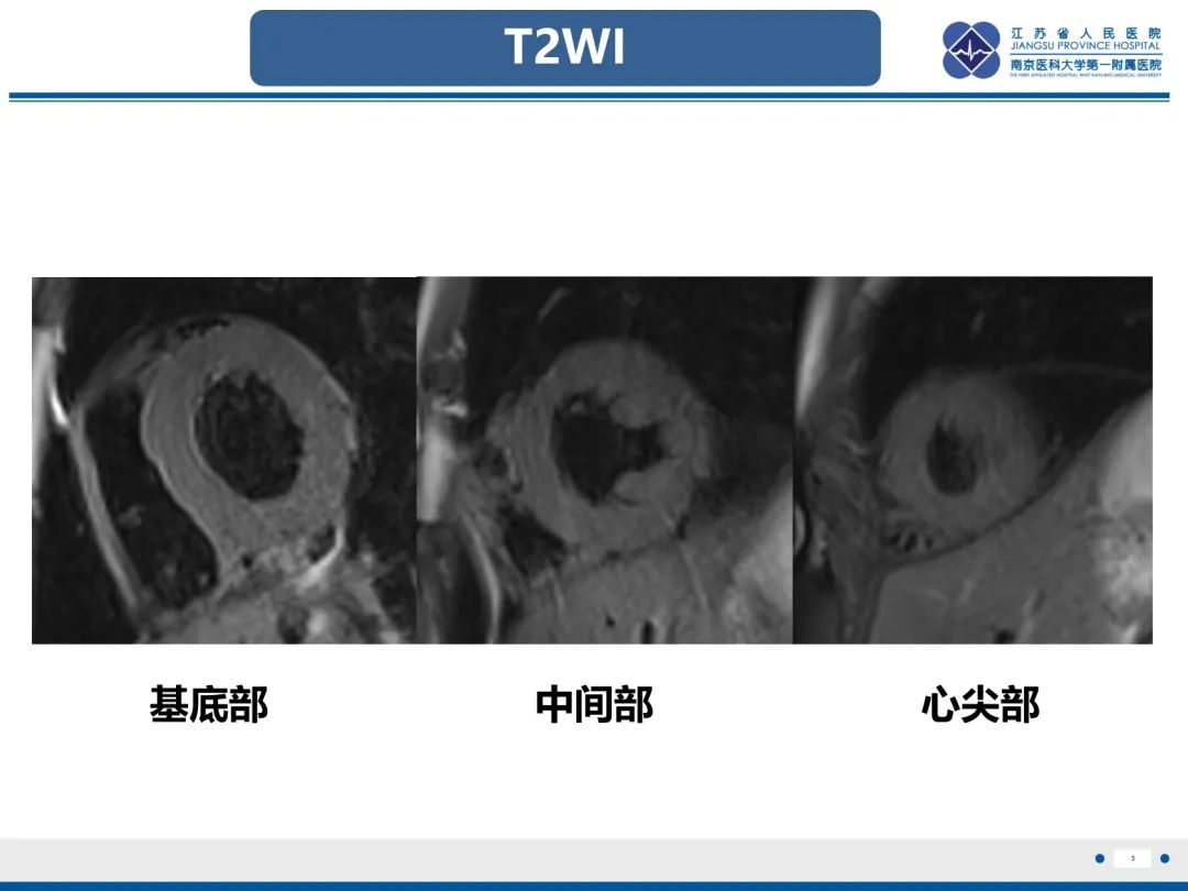 影像PPT - 【PPT】法布里病（Fabry Disease）-6