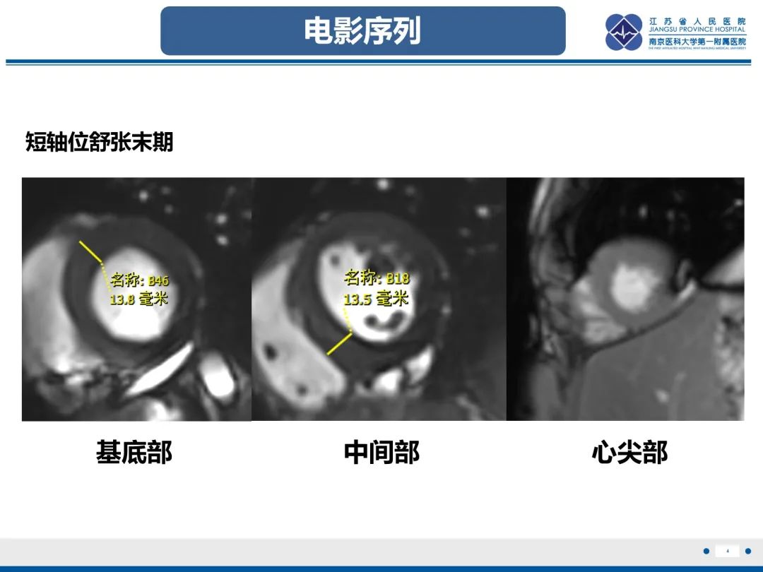 影像PPT - 【PPT】法布里病（Fabry Disease）-5