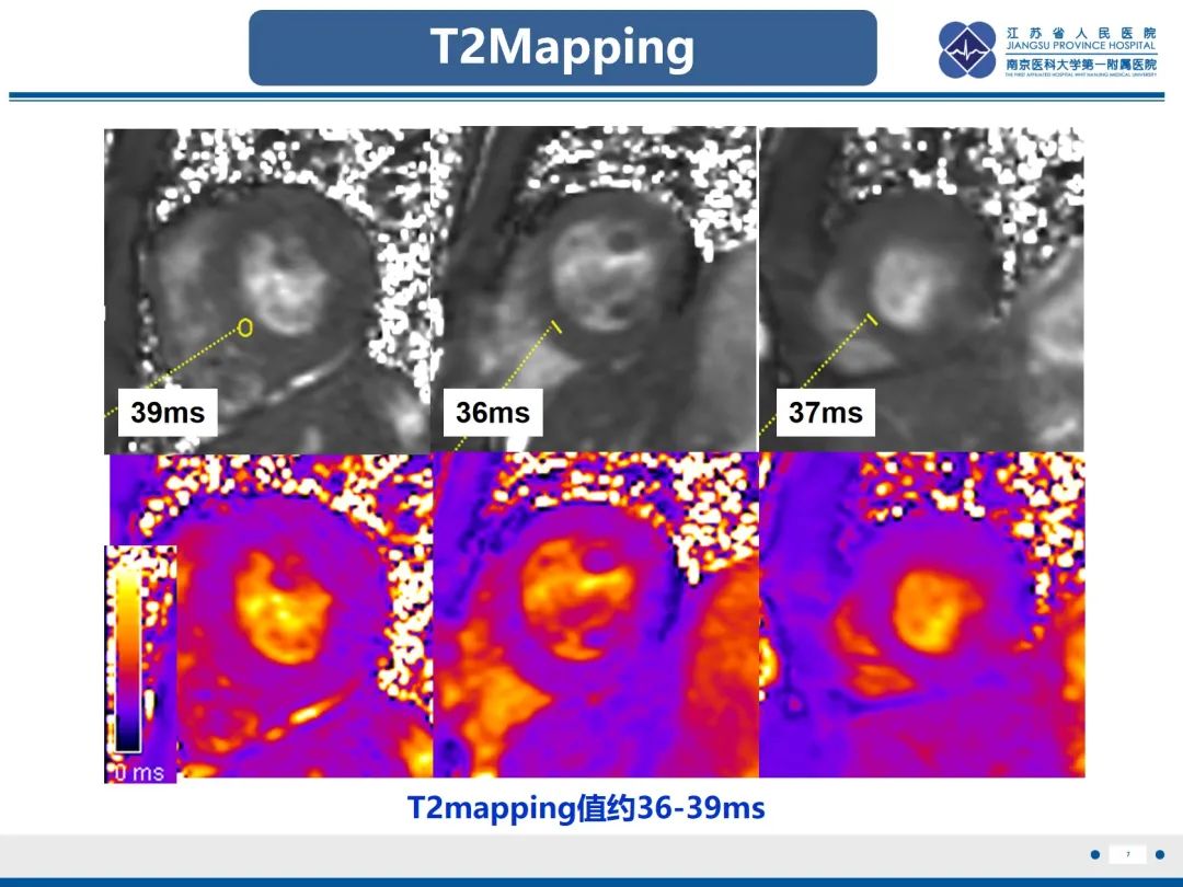 影像PPT - 【PPT】法布里病（Fabry Disease）-8
