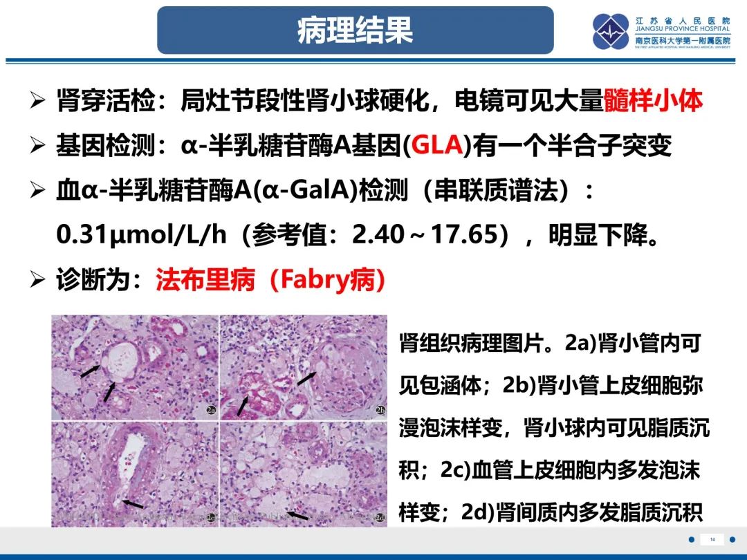 影像PPT - 【PPT】法布里病（Fabry Disease）-15