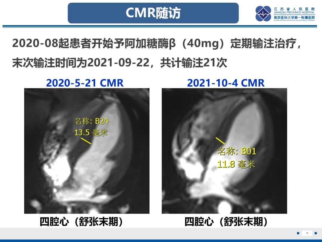 影像PPT - 【PPT】法布里病（Fabry Disease）-16
