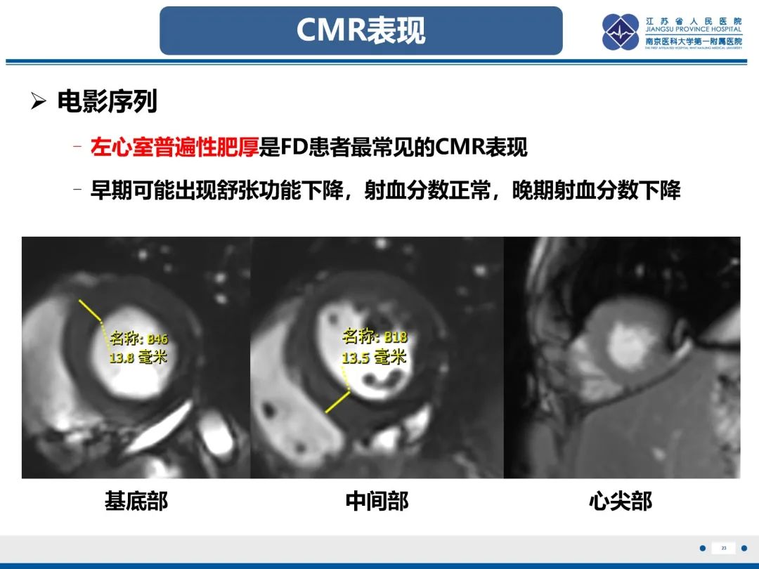 影像PPT - 【PPT】法布里病（Fabry Disease）-24