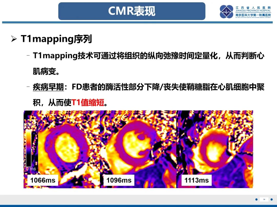 影像PPT - 【PPT】法布里病（Fabry Disease）-25