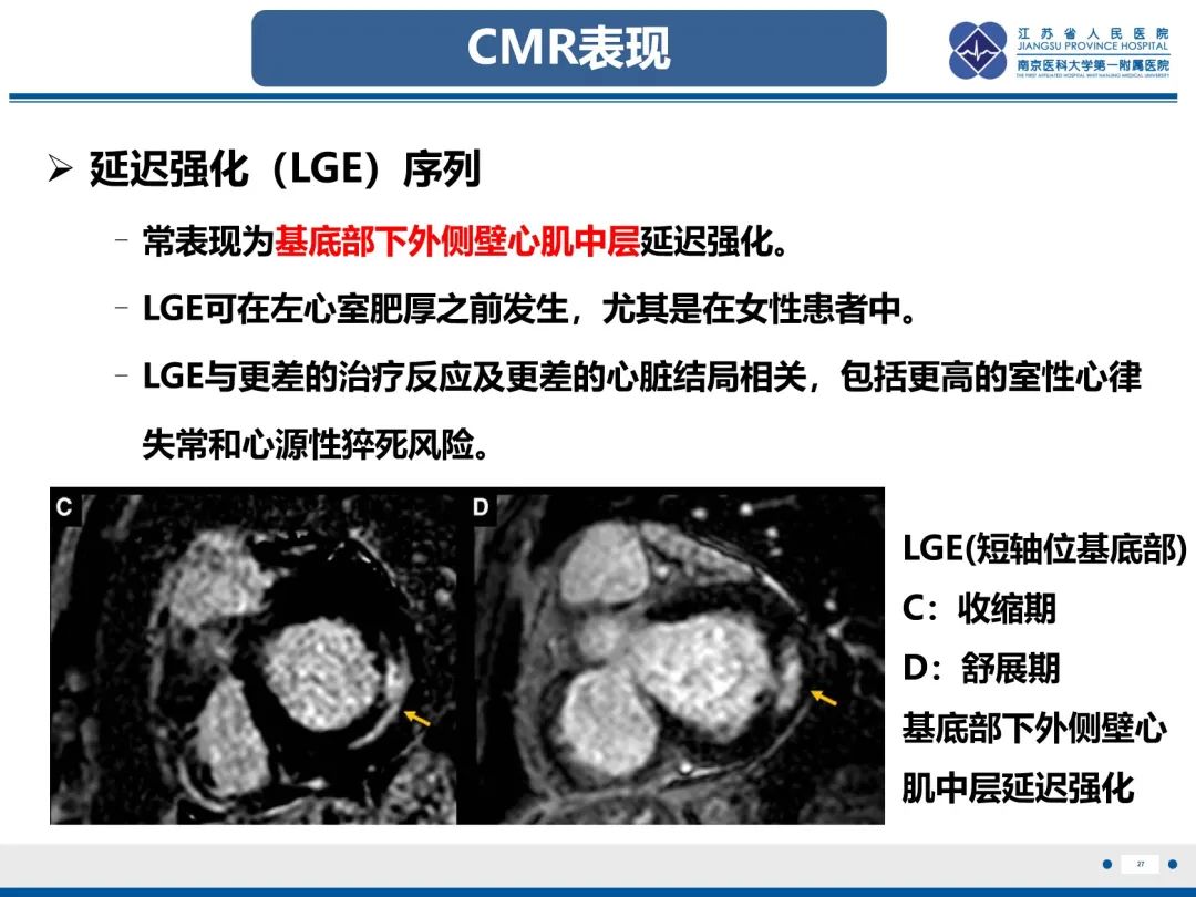 影像PPT - 【PPT】法布里病（Fabry Disease）-28