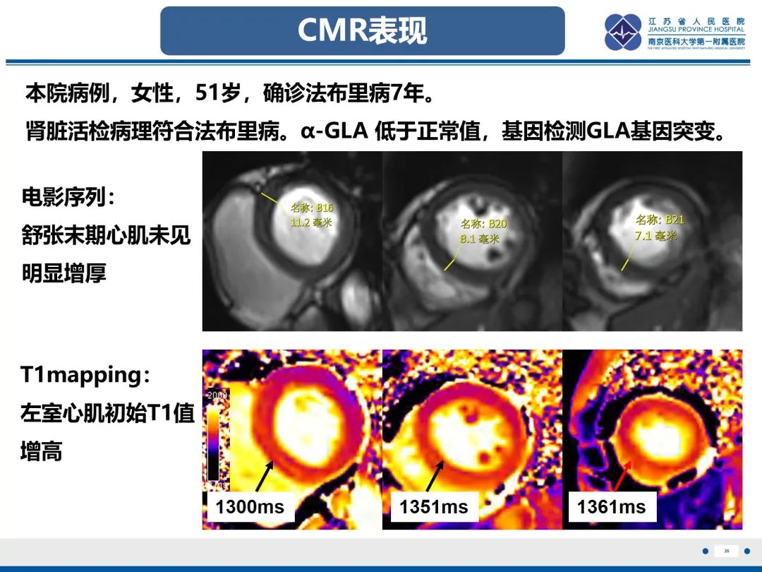 影像PPT - 【PPT】法布里病（Fabry Disease）-27