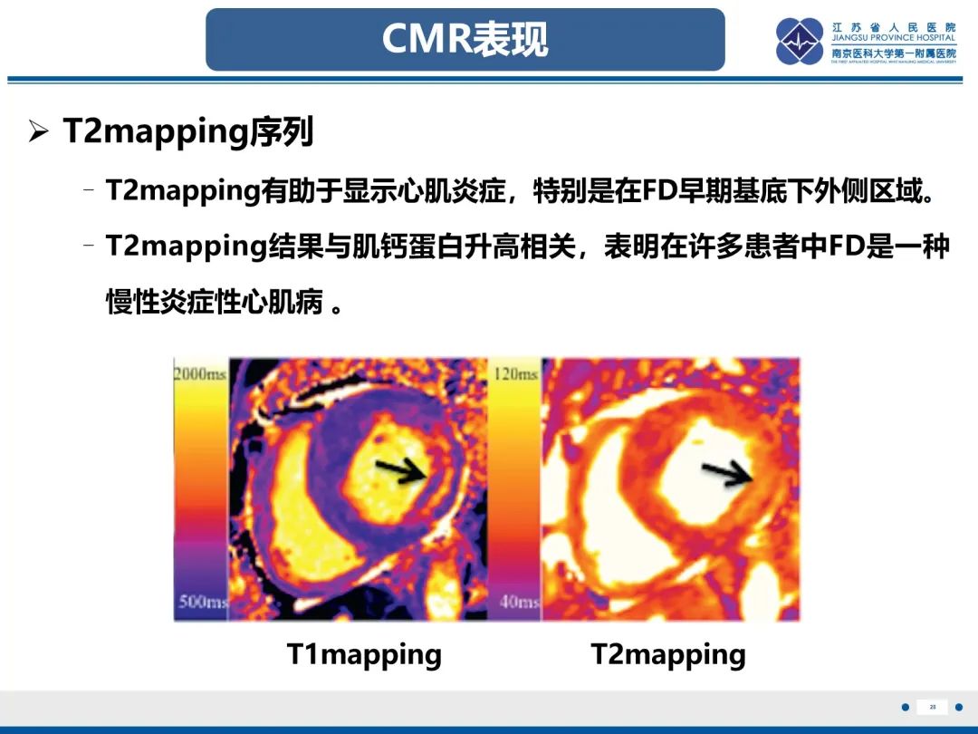 影像PPT - 【PPT】法布里病（Fabry Disease）-29