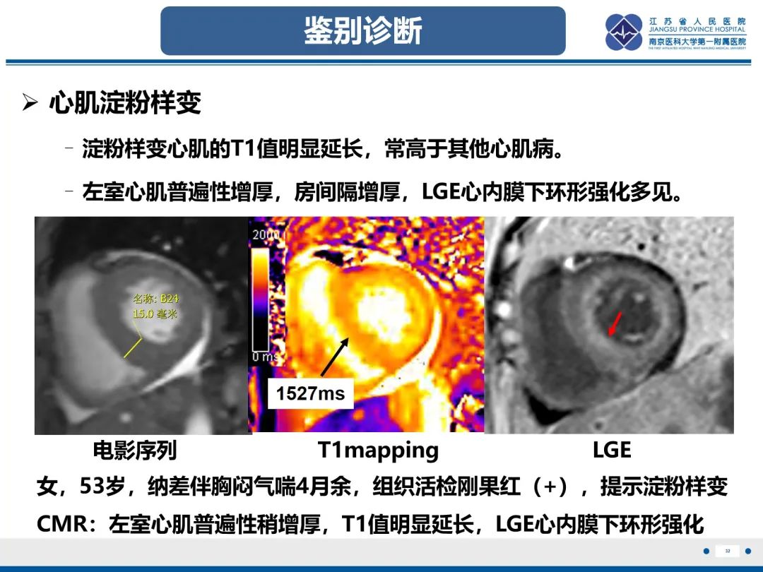 影像PPT - 【PPT】法布里病（Fabry Disease）-33