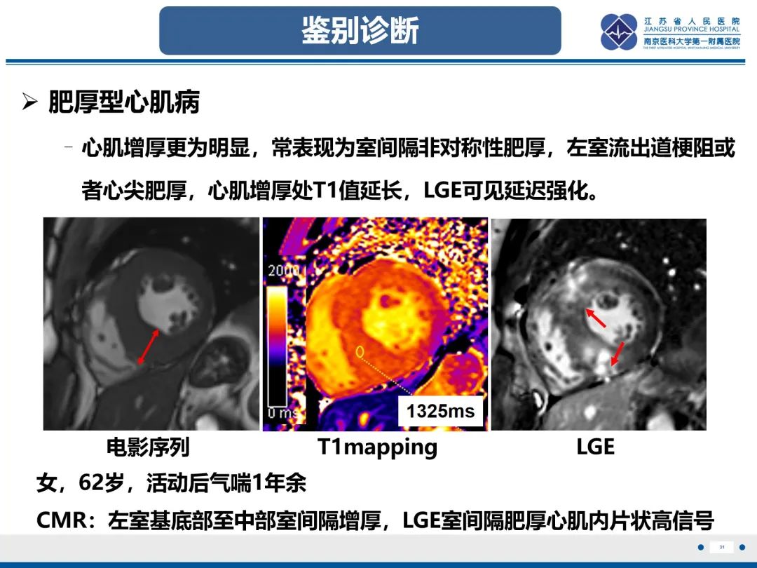 影像PPT - 【PPT】法布里病（Fabry Disease）-32