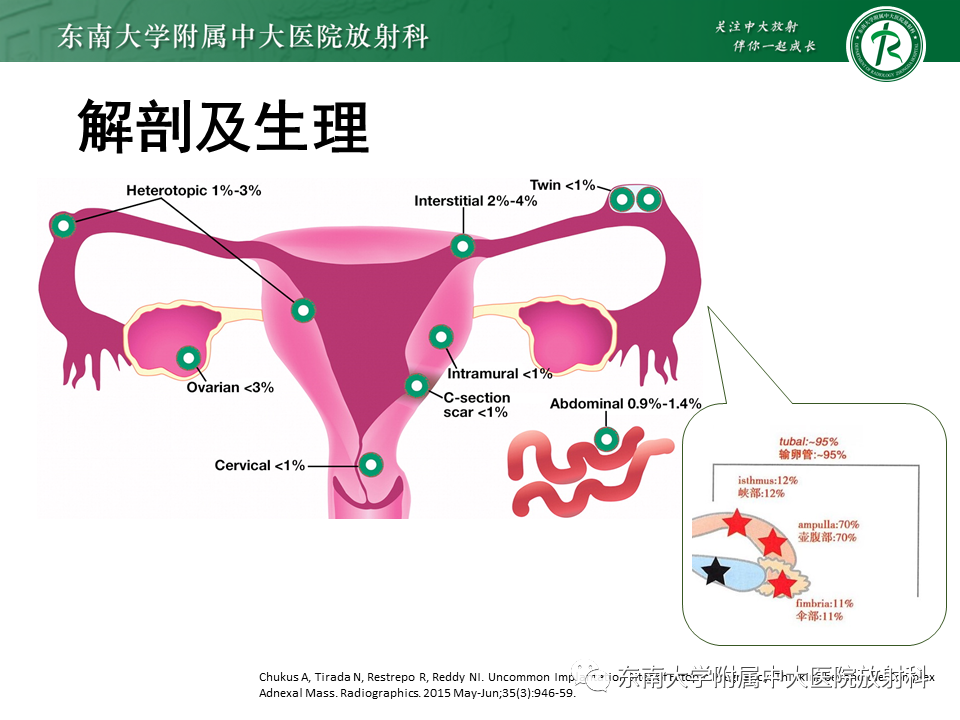 影像PPT - 【PPT】异位妊娠-10 影像PPT - 【PPT】异位妊娠-10