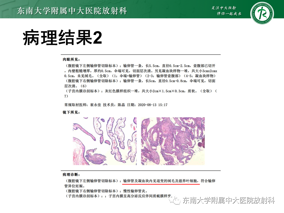 影像PPT - 【PPT】异位妊娠-6 影像PPT - 【PPT】异位妊娠-6
