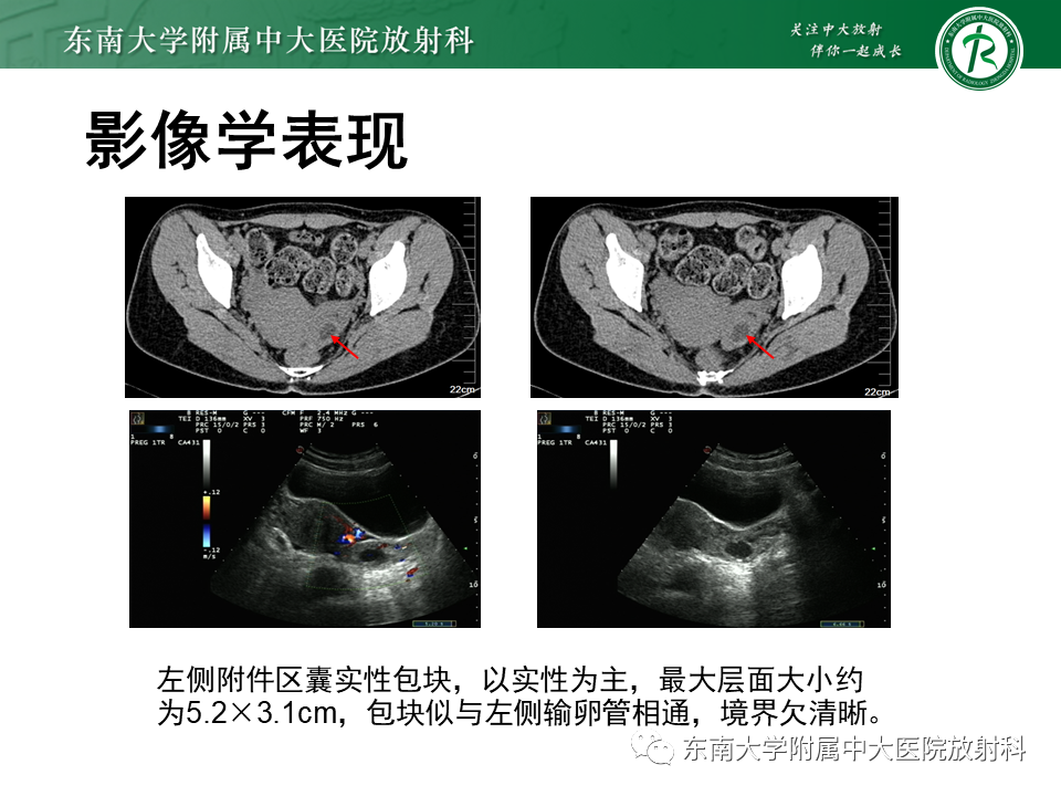 影像PPT - 【PPT】异位妊娠-3 影像PPT - 【PPT】异位妊娠-3