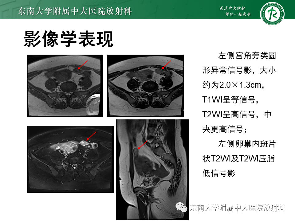 影像PPT - 【PPT】异位妊娠-5 影像PPT - 【PPT】异位妊娠-5
