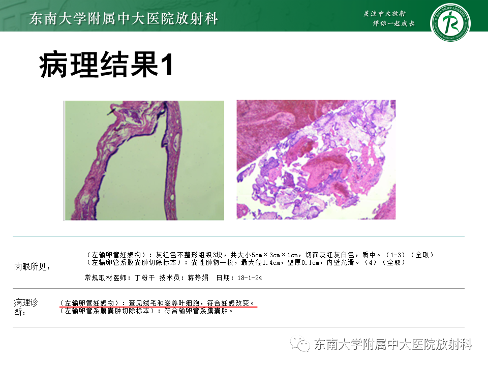 影像PPT - 【PPT】异位妊娠-4 影像PPT - 【PPT】异位妊娠-4