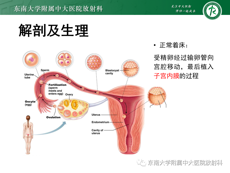 影像PPT - 【PPT】异位妊娠-9 影像PPT - 【PPT】异位妊娠-9
