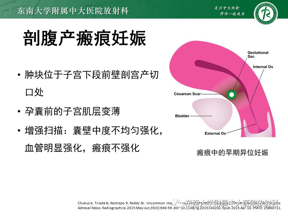 影像PPT - 【PPT】异位妊娠-22 影像PPT - 【PPT】异位妊娠-22