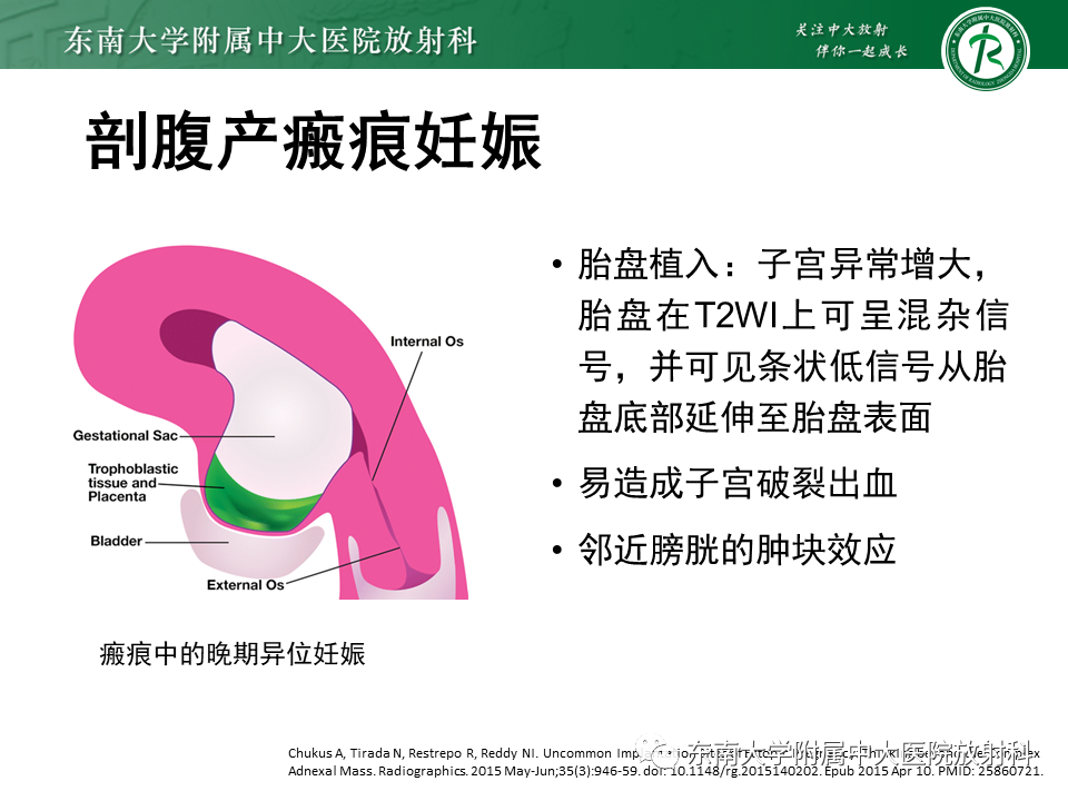 影像PPT - 【PPT】异位妊娠-23 影像PPT - 【PPT】异位妊娠-23