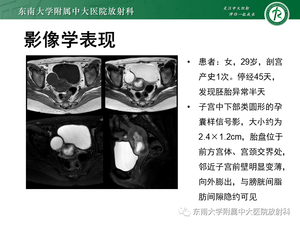 影像PPT - 【PPT】异位妊娠-24 影像PPT - 【PPT】异位妊娠-24