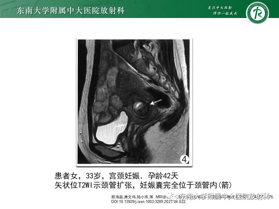 影像PPT - 【PPT】异位妊娠-26 影像PPT - 【PPT】异位妊娠-26