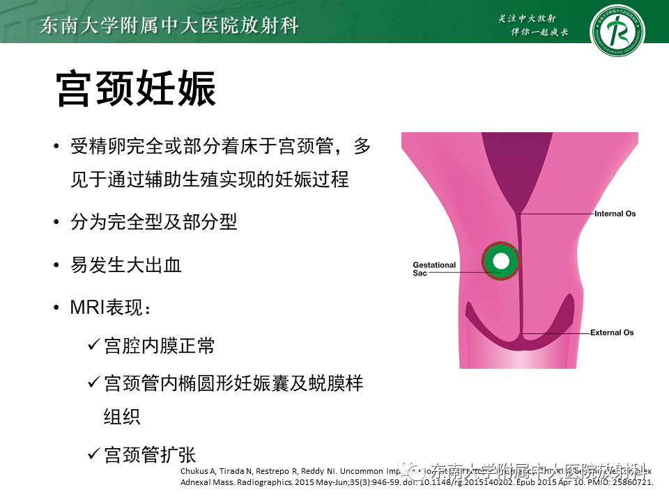 影像PPT - 【PPT】异位妊娠-25 影像PPT - 【PPT】异位妊娠-25