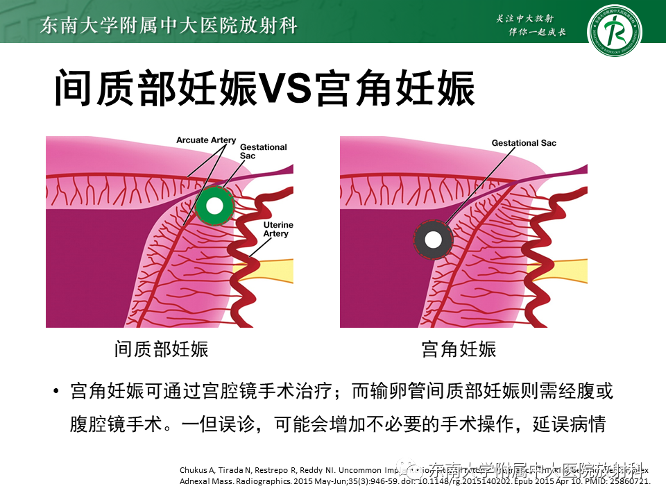 影像PPT - 【PPT】异位妊娠-28 影像PPT - 【PPT】异位妊娠-28