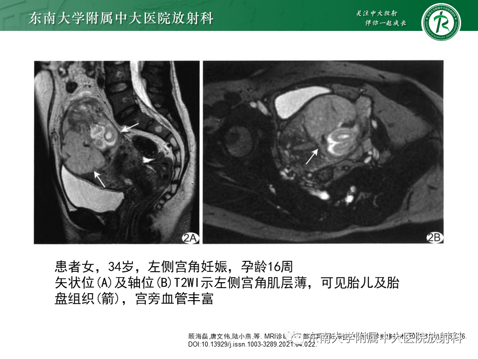影像PPT - 【PPT】异位妊娠-30 影像PPT - 【PPT】异位妊娠-30
