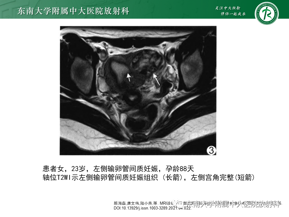 影像PPT - 【PPT】异位妊娠-31 影像PPT - 【PPT】异位妊娠-31