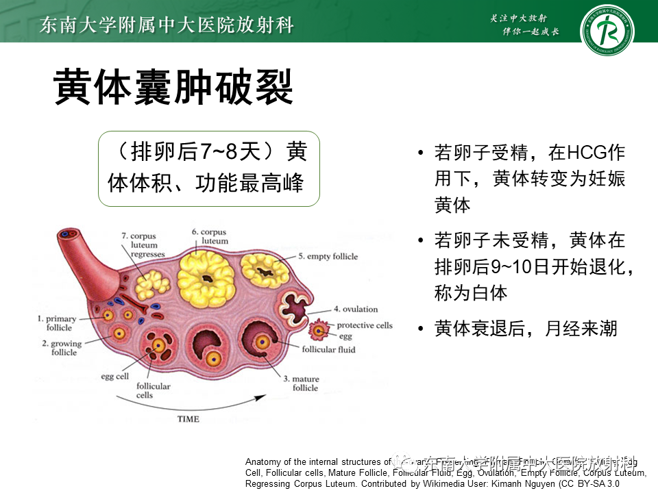 影像PPT - 【PPT】异位妊娠-34 影像PPT - 【PPT】异位妊娠-34