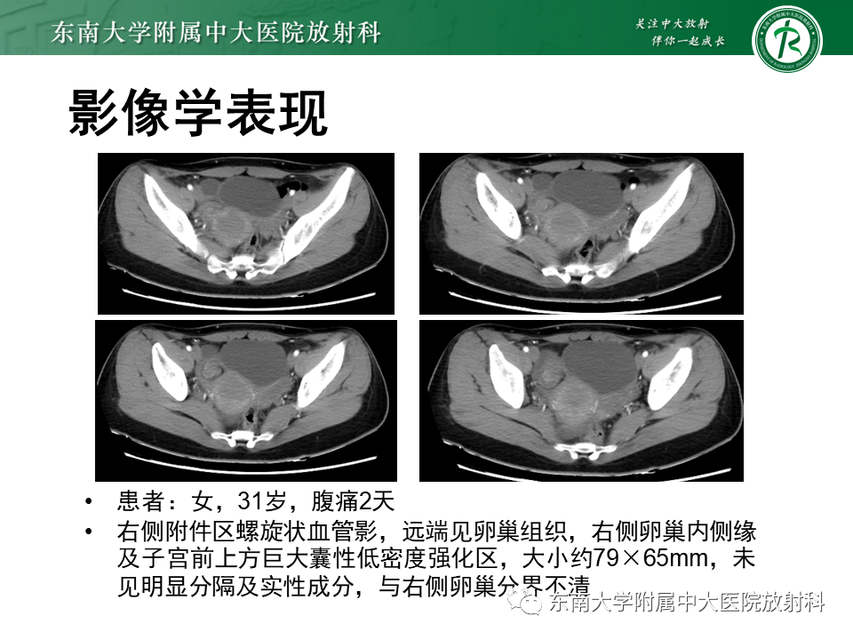 影像PPT - 【PPT】异位妊娠-40 影像PPT - 【PPT】异位妊娠-40