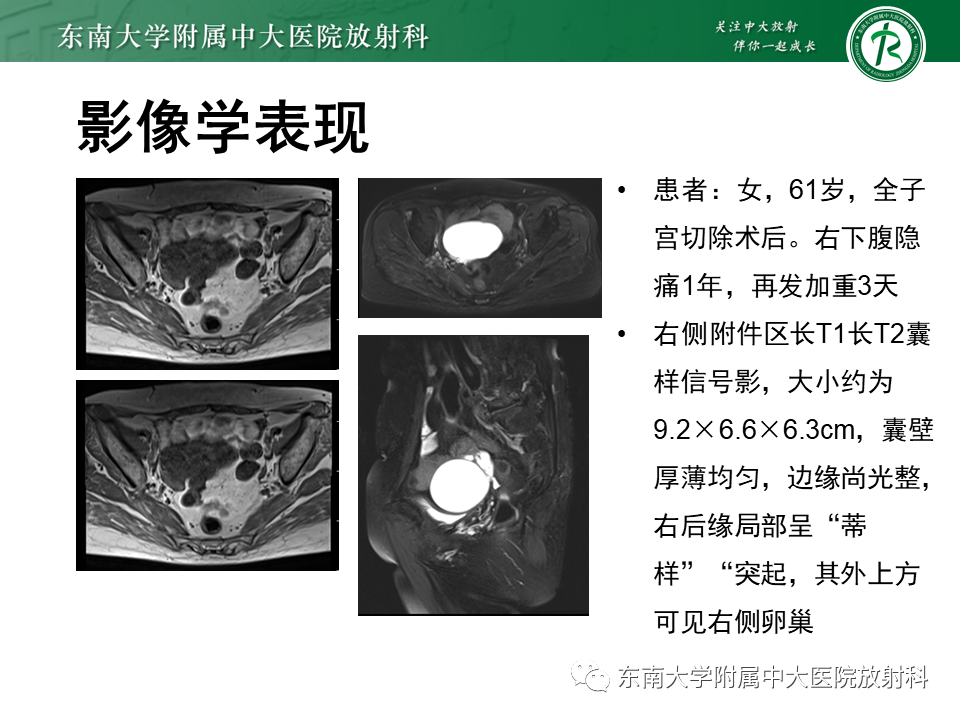 影像PPT - 【PPT】异位妊娠-41 影像PPT - 【PPT】异位妊娠-41
