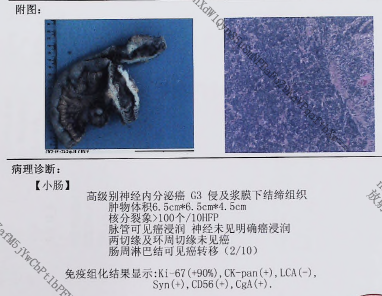 影像PPT - 小肠间质瘤影像表现-15 影像PPT - 小肠间质瘤影像表现-15