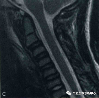 影像PPT - 什么是假性半脱位-5 影像PPT - 什么是假性半脱位-5