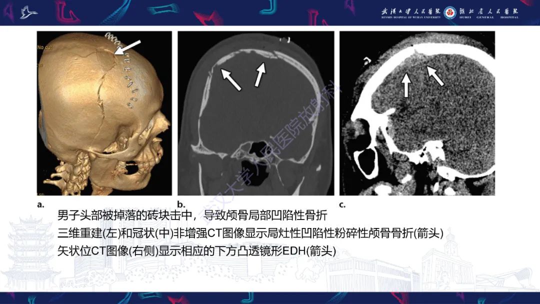 影像PPT - 【PPT】脑外伤及其并发症影像诊断-12