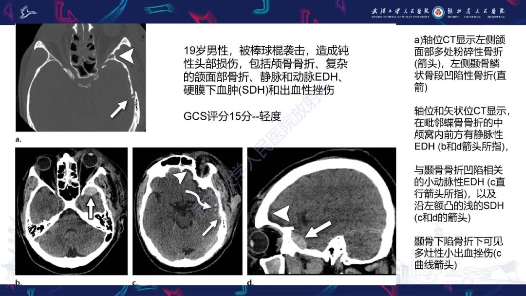 影像PPT - 【PPT】脑外伤及其并发症影像诊断-10