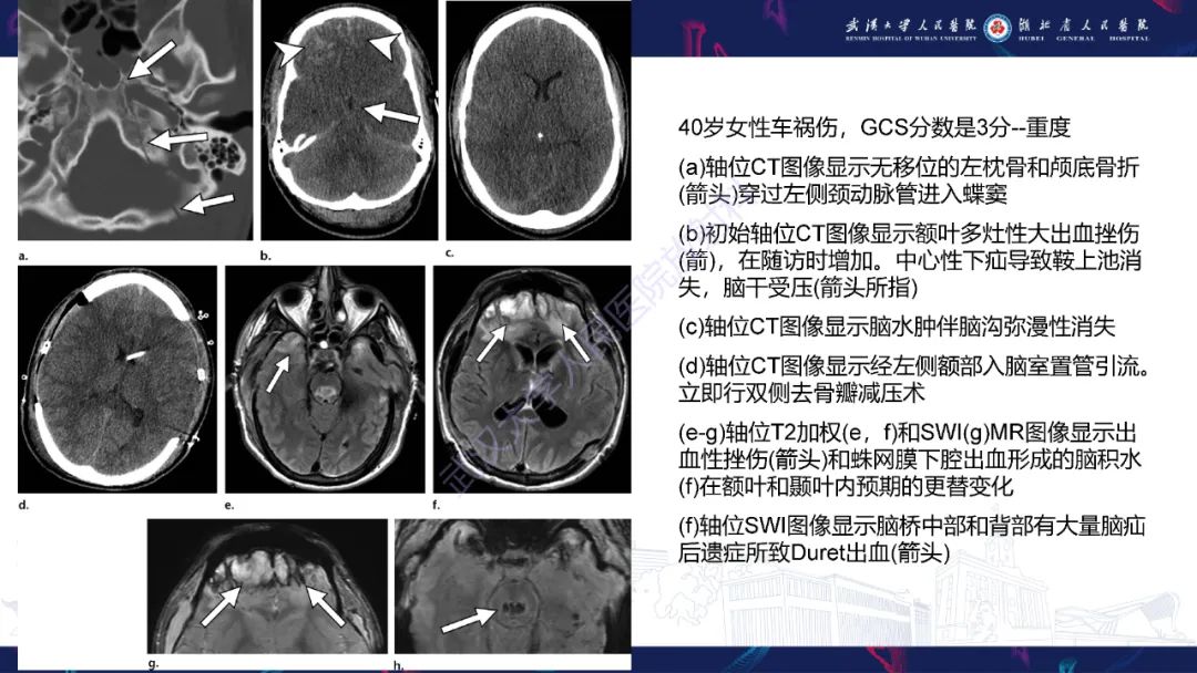 影像PPT - 【PPT】脑外伤及其并发症影像诊断-14