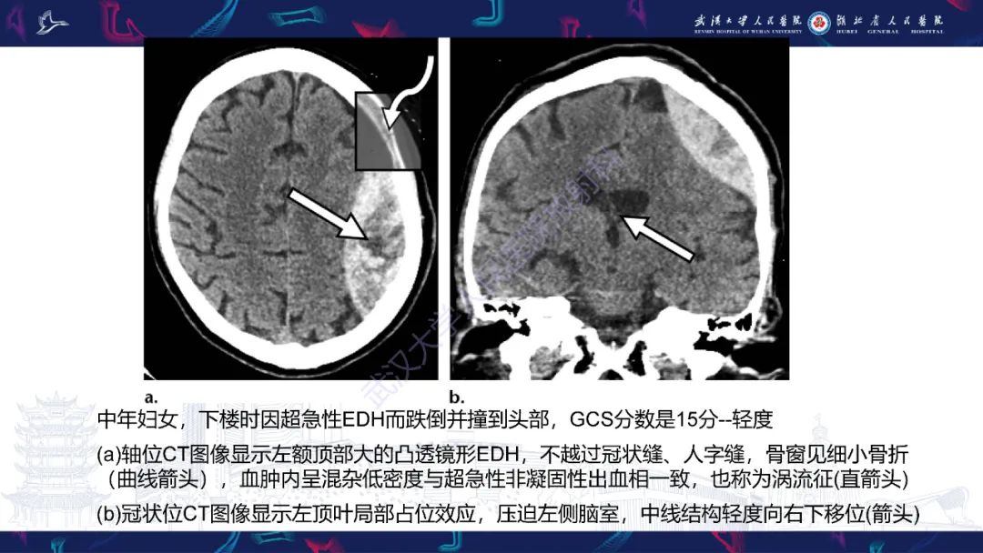 影像PPT - 【PPT】脑外伤及其并发症影像诊断-16