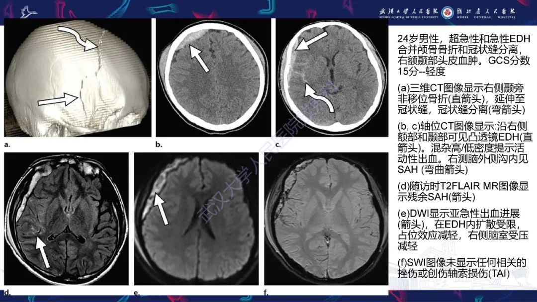 影像PPT - 【PPT】脑外伤及其并发症影像诊断-17