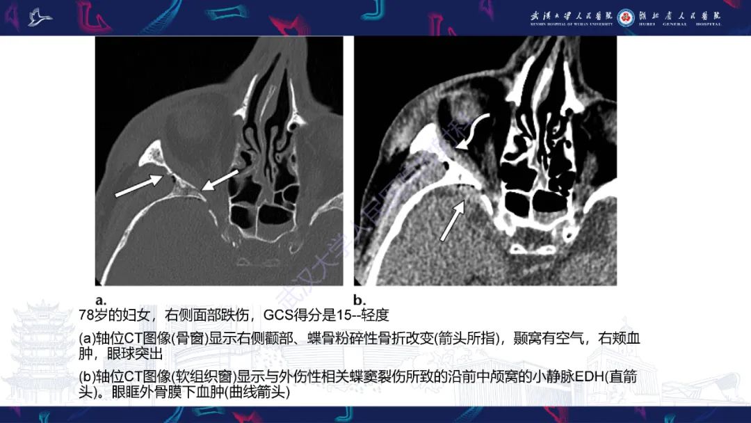 影像PPT - 【PPT】脑外伤及其并发症影像诊断-18