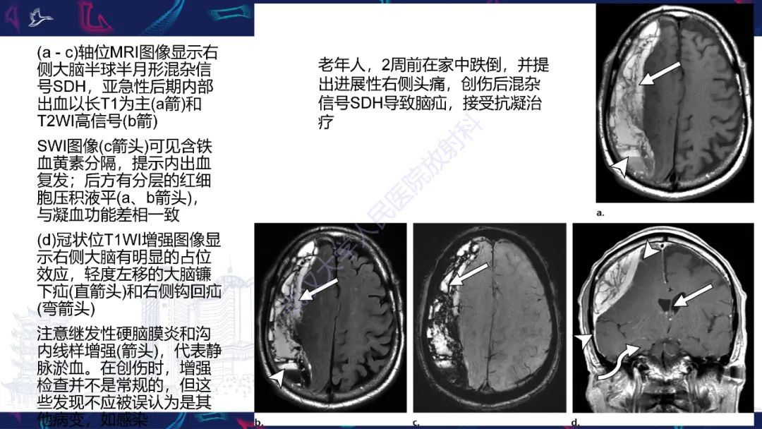 影像PPT - 【PPT】脑外伤及其并发症影像诊断-20