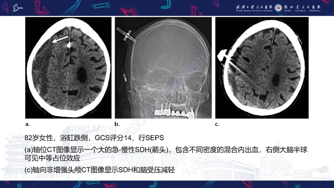影像PPT - 【PPT】脑外伤及其并发症影像诊断-21
