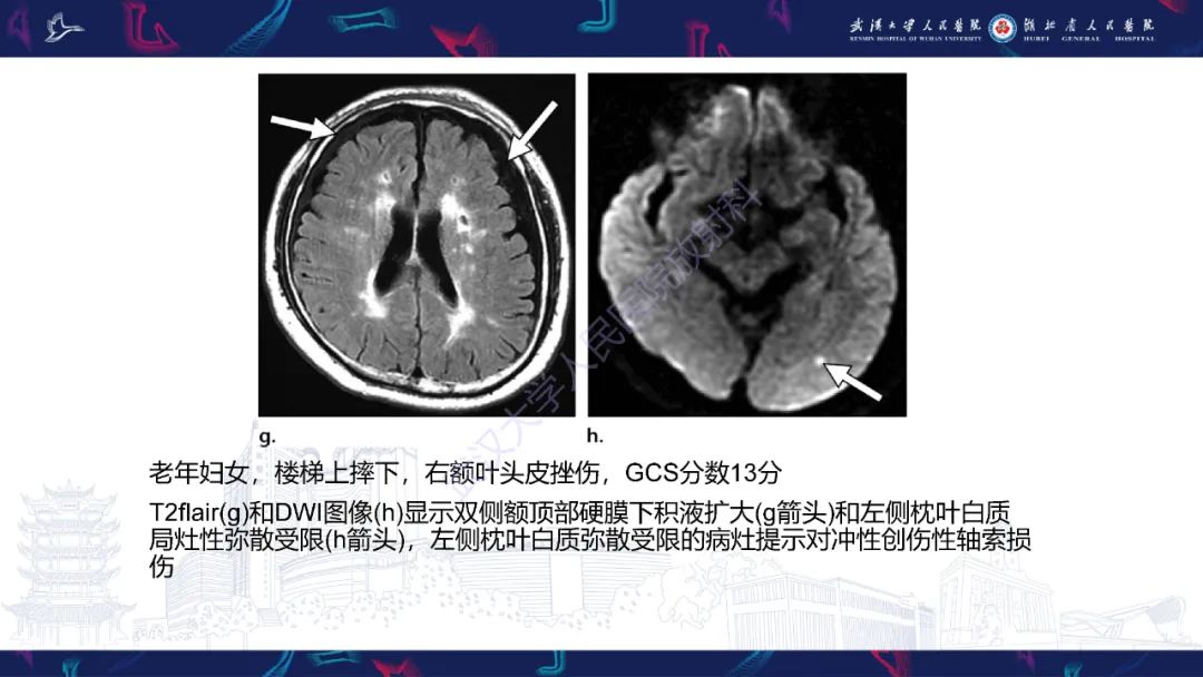 影像PPT - 【PPT】脑外伤及其并发症影像诊断-24