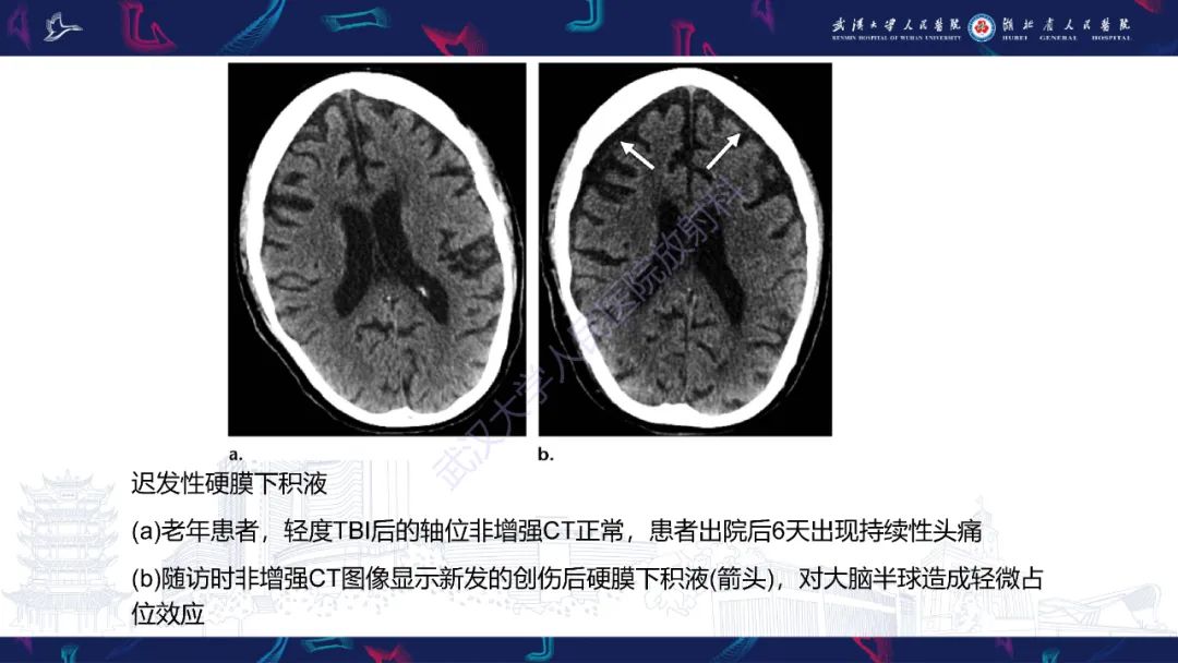 影像PPT - 【PPT】脑外伤及其并发症影像诊断-25