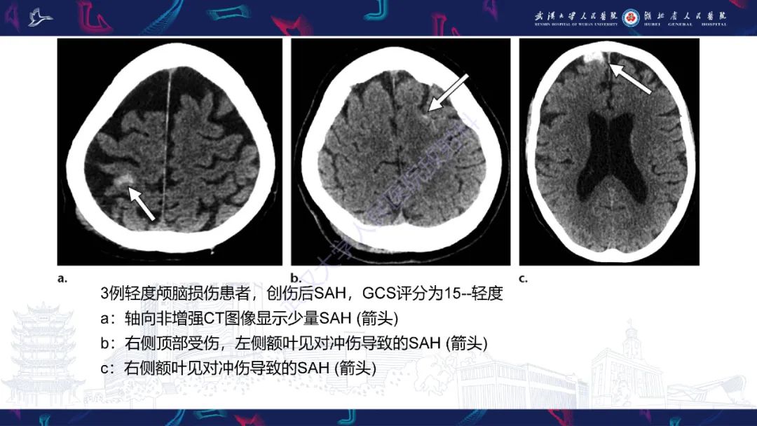 影像PPT - 【PPT】脑外伤及其并发症影像诊断-27