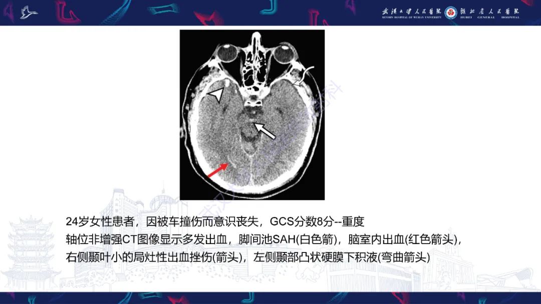 影像PPT - 【PPT】脑外伤及其并发症影像诊断-28