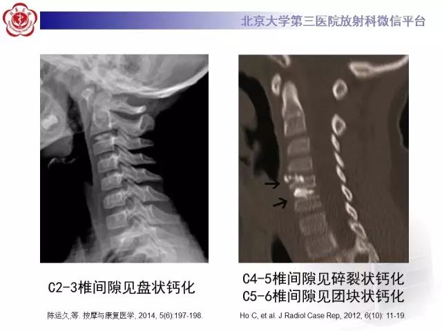 影像PPT - 【PPT】儿童钙化性椎间盘病-9