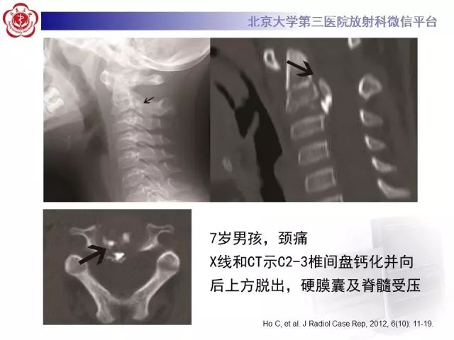 影像PPT - 【PPT】儿童钙化性椎间盘病-11