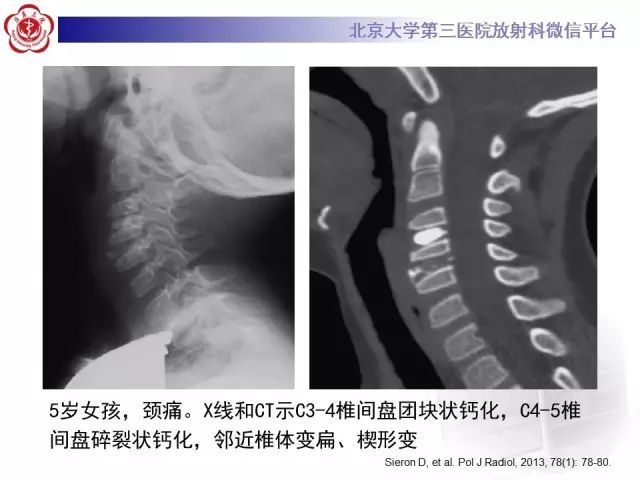 影像PPT - 【PPT】儿童钙化性椎间盘病-14