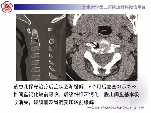 影像PPT - 【PPT】儿童钙化性椎间盘病-12