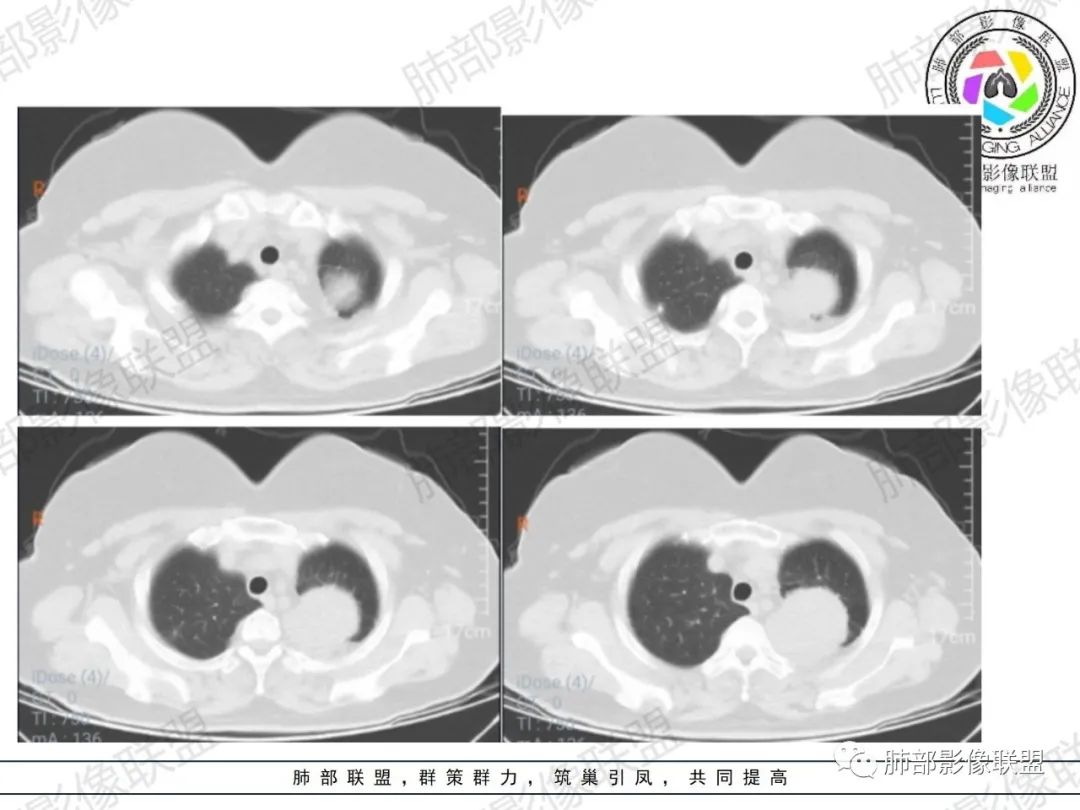 影像PPT - 【病例】左肺占位?纵隔占位?-3 影像PPT - 【病例】左肺占位?纵隔占位?-3