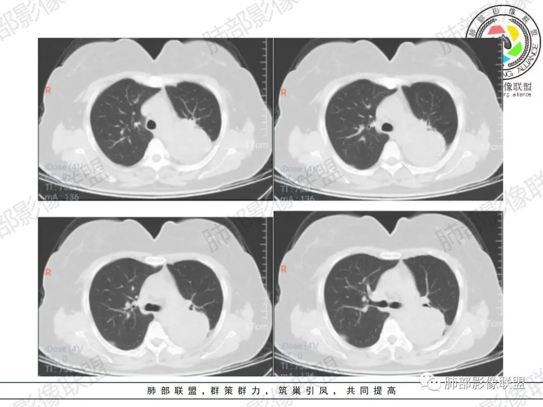 影像PPT - 【病例】左肺占位?纵隔占位?-5 影像PPT - 【病例】左肺占位?纵隔占位?-5